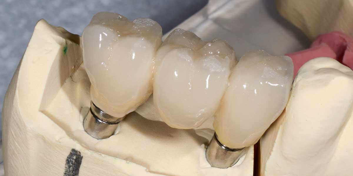 Dental Implant Supported Bridge in NJ