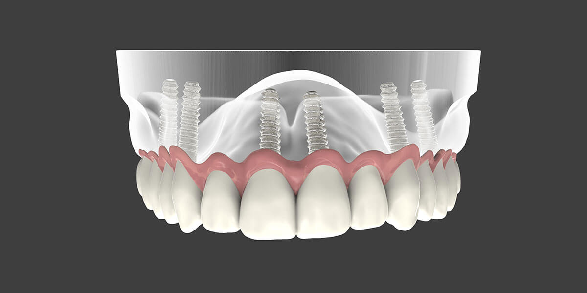 Dental Implant Supported Dentures in NJ