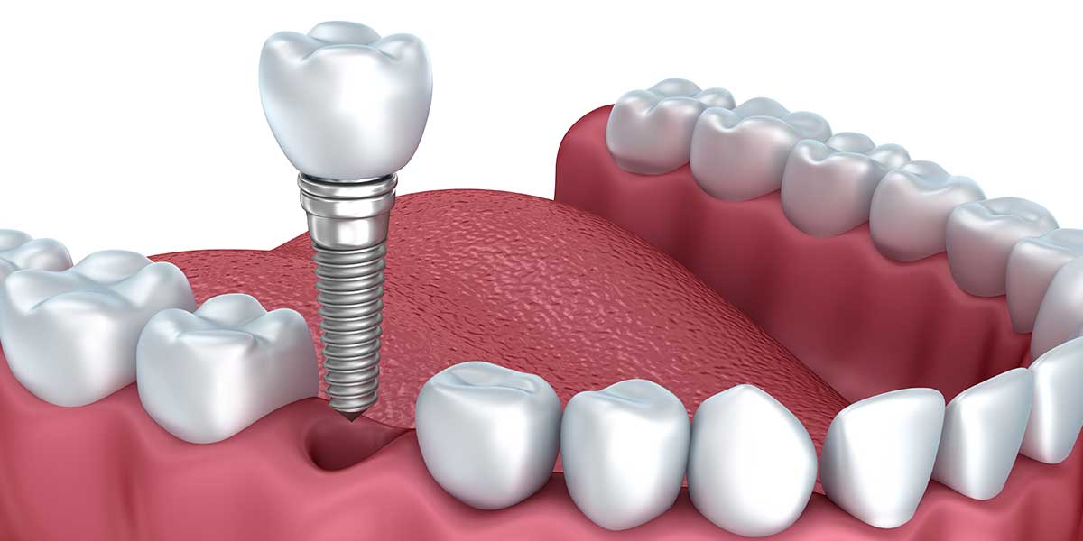 Single Dental Implants in Wayne, NJ