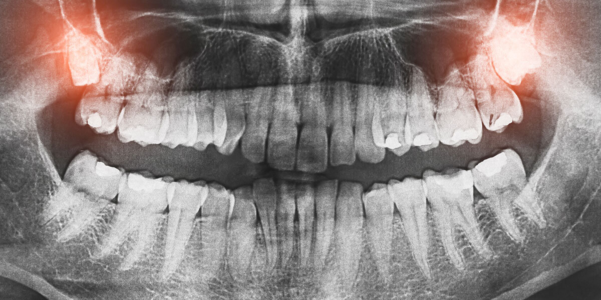 xray showing impacted wisdom teeth