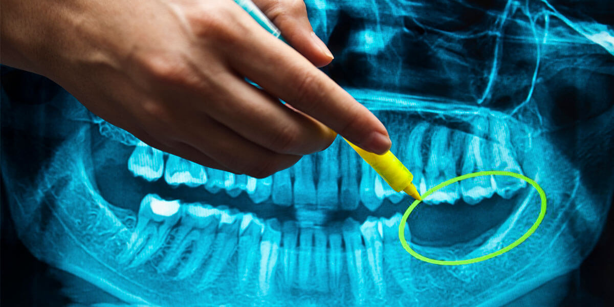 Benefits of Dental Implants in Wayne