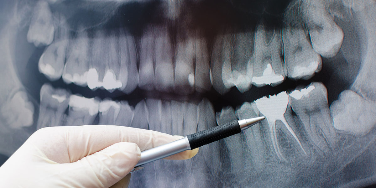 Guided Dental Implant Placement in NJ