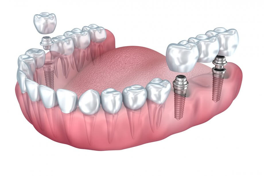 Dental Implant vs Bridge